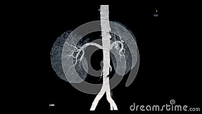 CTA Renal artery 3D is a medical imaging procedure using CT scans to examine the renal arteries It provides detailed images of the Stock Photo
