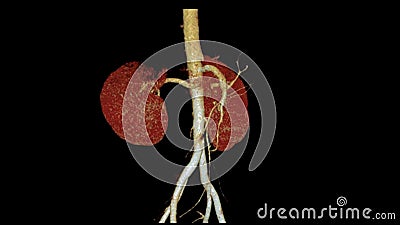 CTA Renal artery 3D is a medical imaging procedure using CT scans to examine the renal arteries It provides detailed images of the Stock Photo