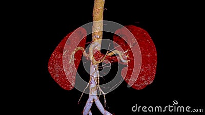 CTA Renal artery 3D is a medical imaging procedure using CT scans to examine the renal arteries It provides detailed images of the Stock Photo