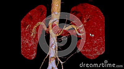 CTA Renal artery 3D is a medical imaging procedure using CT scans to examine the renal arteries It provides detailed images of the Stock Photo