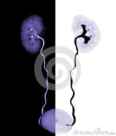 CTA Renal artery 3D rendering image showing both kidney, Ureter and bladder Stock Photo