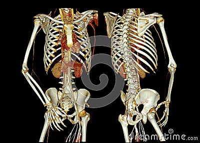 CTA whole aorta and brachial artery 3D rendering image in case patient tramatic Stock Photo