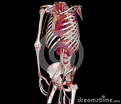 CTA whole aorta and brachial artery 3D rendering image in case patient tramatic Stock Photo