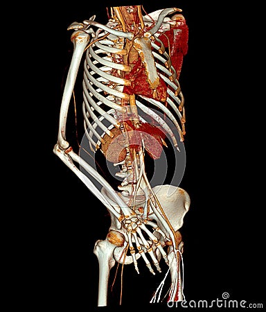 CTA whole aorta and brachial artery 3D rendering image in case patient tramatic Stock Photo