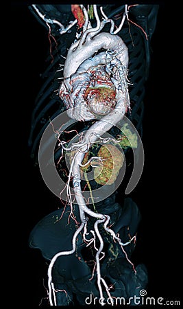 CTA Whole aorta 3D rendering image on black background for detect aortic aneurysm Stock Photo