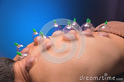 Cup massage in general. Vacuum jars for back massage for a man. Massage with vacuum cups. Cupping treatments for back Stock Photo