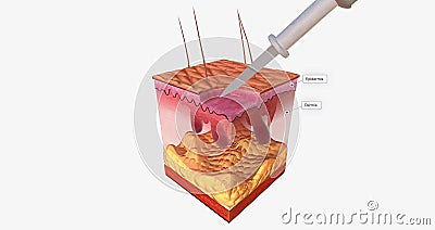 The Curettage and Electrodesiccation Close Up Stock Photo