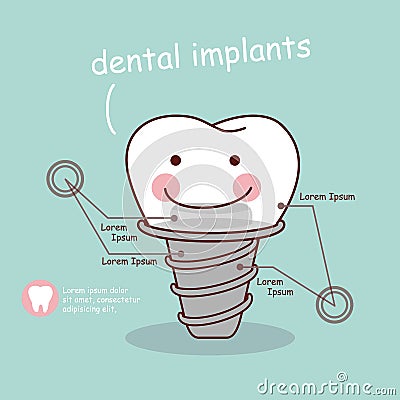 Cute cartoon tooth implant Vector Illustration