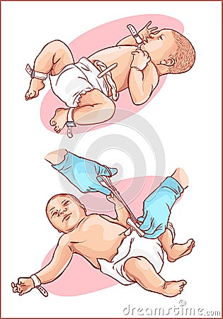 Cutting of the umbilical cord on a newborn baby Vector Illustration