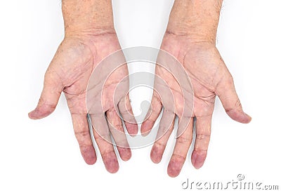 Cyanotic hands or central cyanosis or blue hands at Asian young man with congenital heart disease Stock Photo