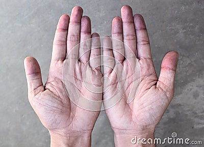 Cyanotic hands or peripheral cyanosis or blue hands at Asian man Stock Photo