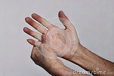 Cyanotic hands or peripheral cyanosis or blue hands at Asian man Stock Photo