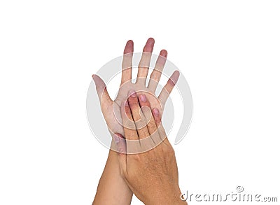 Cyanotic hands or peripheral cyanosis or blue hands at Asian man Stock Photo