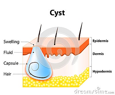 Cyst Vector Illustration
