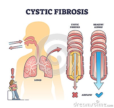 Cystic fibrosis disorder or healthy airflow airway comparison outline diagram Vector Illustration