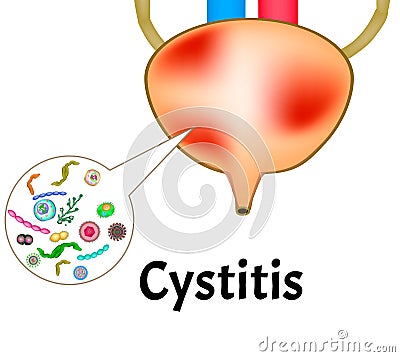 Cystitis. Inflammation of the bladder. The structure of the kidneys and bladder. Excretory system. Infographics. Vector Vector Illustration