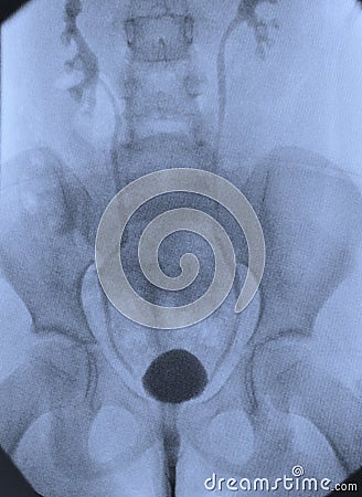 Cystography urological xray image Stock Photo