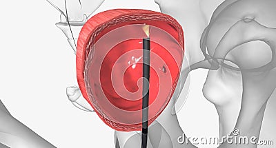 Cystoscope Exploration, It can be used to look for causes of signs or symptoms in the bladder or to look for an abnormal area seen Stock Photo