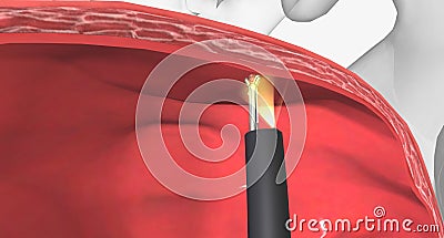 Cystoscopy can be used to take biopsy samples from the bladder or urethra Stock Photo