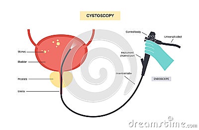 Cystoscopy examination concept Vector Illustration