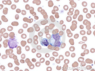 Cytomegalovirus infection. Peripheral blood smear. Stock Photo