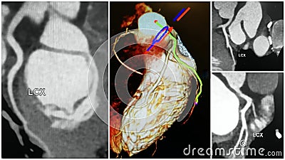 3D angio tomography heart lcx artery collage Stock Photo