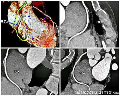 3D angio tomography rca collage Stock Photo