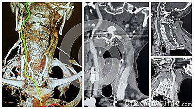 3D angio tomography right internal carotid artery collage Stock Photo