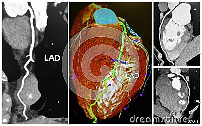 3D angio tomography scan of lad heart collage Stock Photo