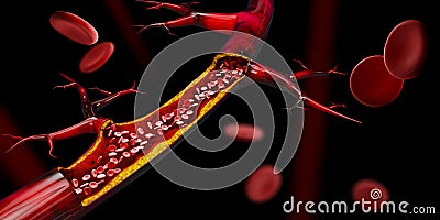 3d illustration of Blocked blood vessel - artery with cholesterol buildup realistic Cartoon Illustration