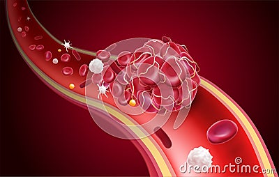 3D illustration of a blood clot in a blood vessel showing a blocked blood flow with platelets and white blood cells in the image Vector Illustration