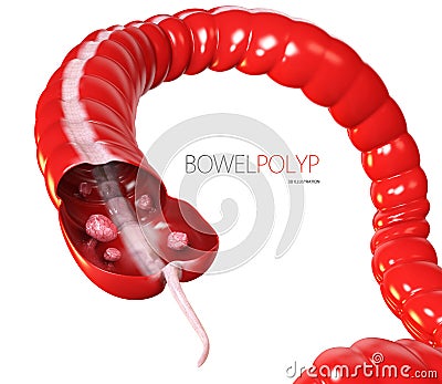 3d illustration of Colon polyps. Polyp in the intestine. isolated white Cartoon Illustration