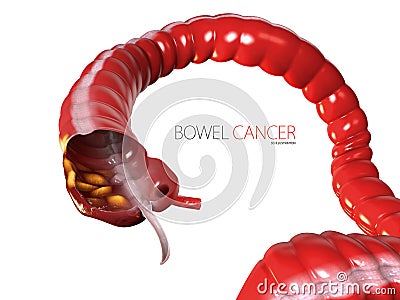 3d Illustration of Colorectal cancer, isolated white background Stock Photo