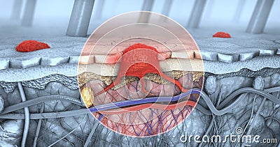 Cross section of a diseased skin with melanoma that enters the bloodstream and lymphatic tract Cartoon Illustration