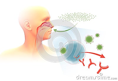 3d illustration depicting the mechanism of allergy in the respiratory system and orl. Stock Photo