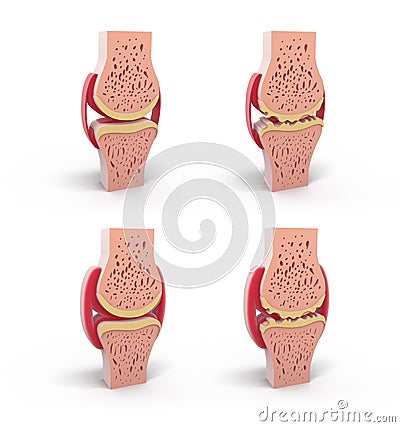 3d illustration of healthy and spherical synovial joint. Cartoon Illustration