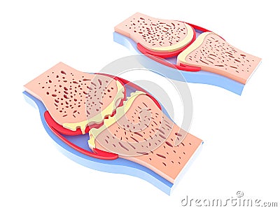 3d illustration of healthy synovial joint and with osteoarthritis. Cartoon Illustration