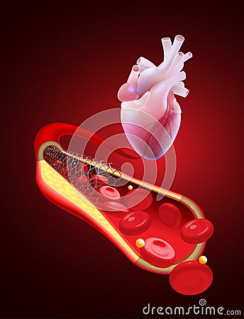 3D illustration of a human coronary artery with normal blood flow after angioplasty with a stent Vector Illustration