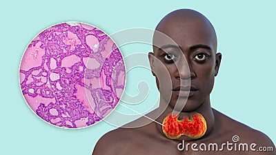 A man with enlarged thyroid gland, 3D illustration, and micrograph toxic goiter Cartoon Illustration