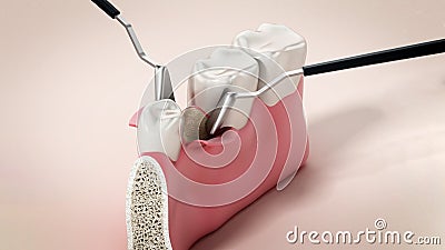 3D illustration of mid-crestal incision dental operation. 3D illustration Cartoon Illustration