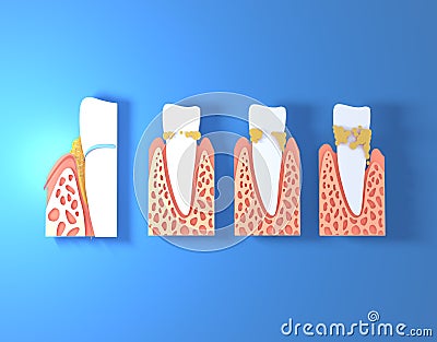 3d illustration of paper teeth with tartar. Showing four different phases in which it evolves and the gums Cartoon Illustration