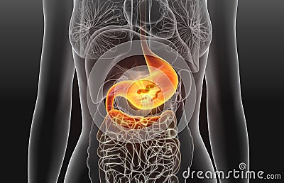 Gastritis, escherichia coli bacteria in stomach, medically concept, 3D illustration Stock Photo