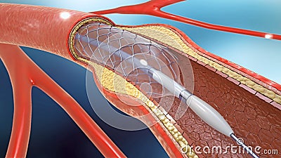 Stent implantation for supporting blood circulation into blood vessels Cartoon Illustration