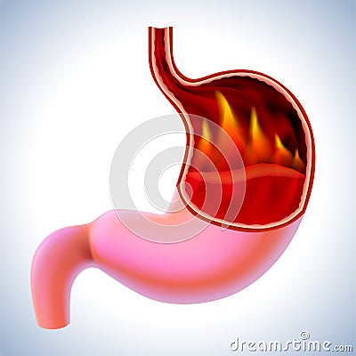 3D illustration of a stomach with flames burning inside is a sign of burning pain, a symptom of gastritis Vector Illustration