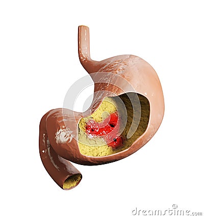 3d illustration of Stomach ulcer, human stomach anatomy Cartoon Illustration