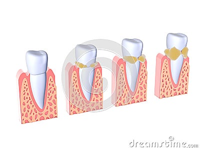 3d illustration of teeth with tartar. Showing four different phases in which it evolves and the gums. Cartoon Illustration