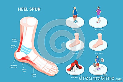 3D Isometric Flat Vector Conceptual Illustration of Heel Spur Vector Illustration