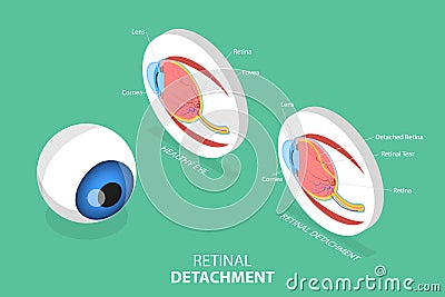 3D Isometric Flat Vector Conceptual Illustration of Retinal Detachment Vector Illustration