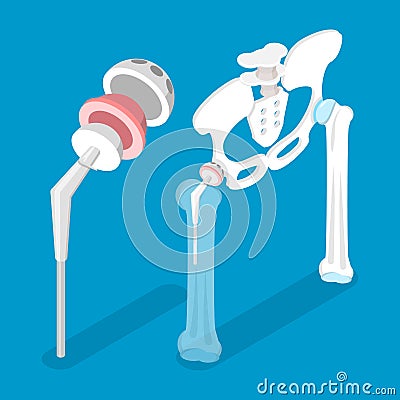 3D Isometric Flat Vector Conceptual Illustration of Total Hip Replacement Vector Illustration