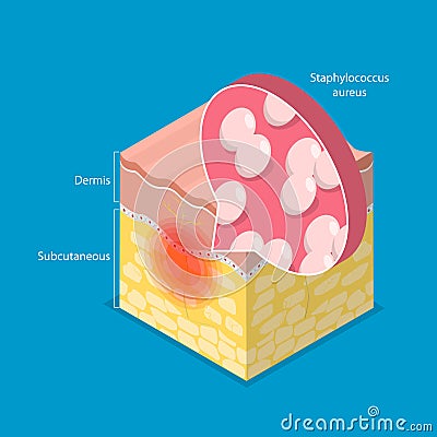 3D Isometric Flat Vector Illustration of Cellulitis Vector Illustration